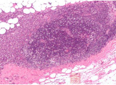 Nature医学 根除侵袭性乳腺癌的新方法