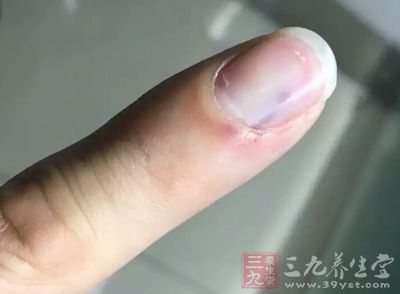 指甲裂伤出血该怎么办