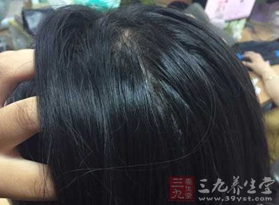 有些人明明不是脱发,但是仍感觉头发变得稀少 有些人明明不是脱发,但是仍感觉头发变得稀少