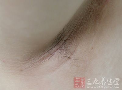 专家诊断由于脱毛不当引起的汗腺炎 专家诊断由于脱毛不当引起的汗腺炎