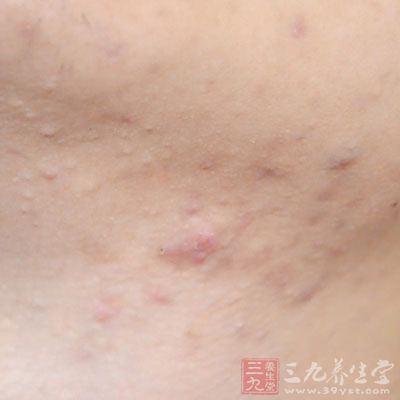 痘痘的類型主要有粉刺、角質(zhì)化丘疹、毛囊炎痘痘三種