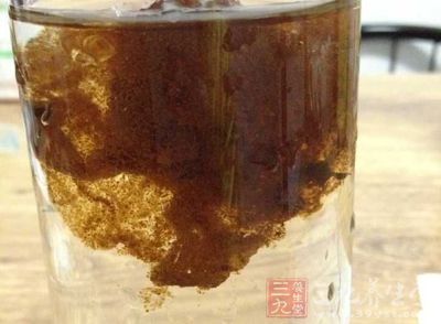 自购清肠茶通便，结果患上结肠黑变病