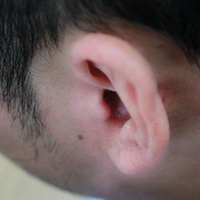 中医辩证治疗化脓性中耳炎