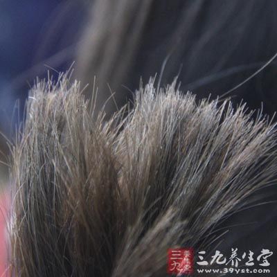 斑秃的原因也一样悬而未决 斑秃的原因也一样悬而未决