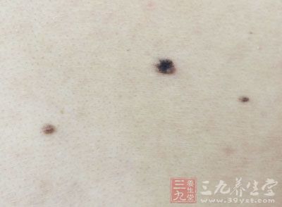 突然长出黑痣是癌变吗