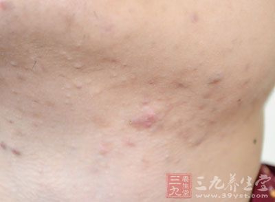 痤疮是毛囊皮脂腺单位的一种慢性炎症性皮肤病