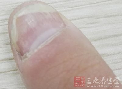 甲癣治疗 女人手上出现这物小心妇科病(3)