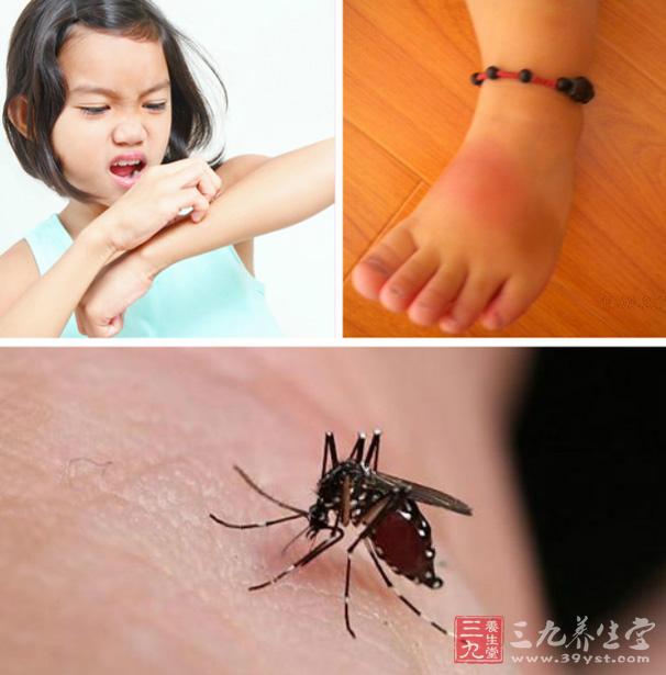 但是,一旦你出现了流感症状(可能是蚊虫叮咬引发的疾病),或者红肿区域