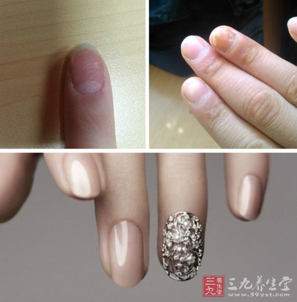 指甲上的肝病信号要小心(3)