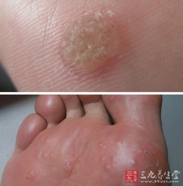 为什么会长鸡眼 鸡眼的病因及症状