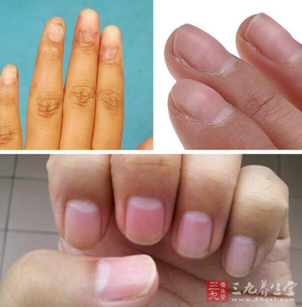 3.如果指甲表面是浅蓝色的底色则对应的是糖尿病.