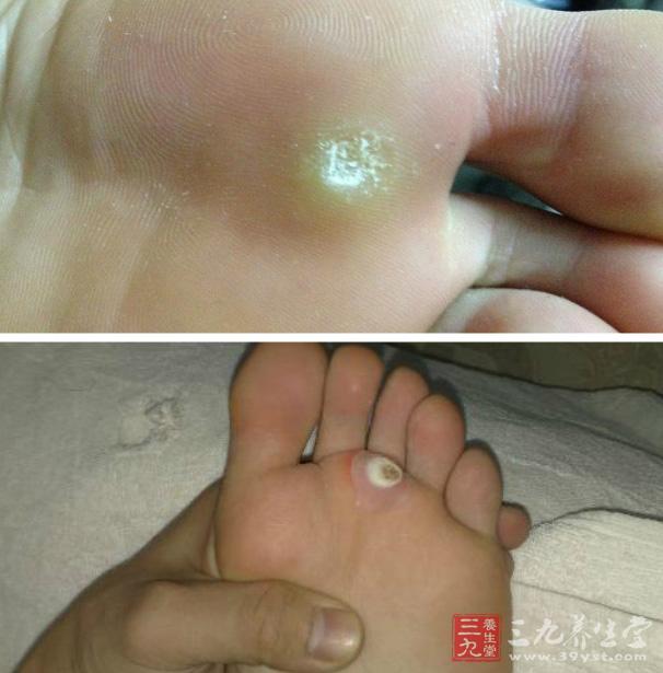 什么是鸡眼 关于鸡眼的一些小知识