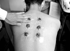 聚焦三伏贴：每伏第一天敷贴效果佳