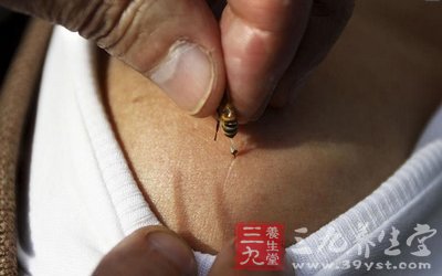 用蜜蜂尾针进行针灸