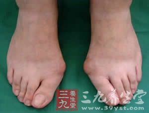 爱穿高跟鞋需小心拇外翻