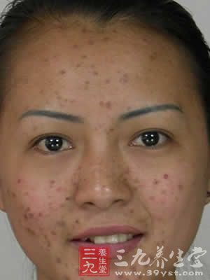 中医袪痘痘袪痘印妙方