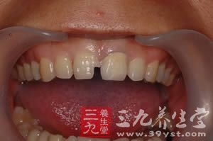 蛀牙诱发牙龈癌 下巴被全切