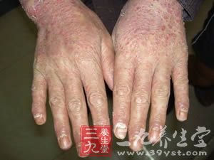 牛皮癣患者宜多吃谷类食物