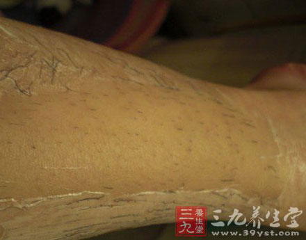 健康脱毛方式大PK 打造夏日嫩滑美肌