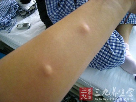 9种过敏源大揭秘巧克力竟也过敏 