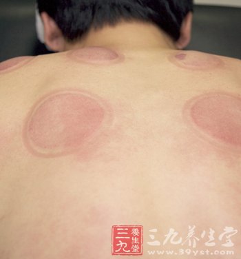背部拔火罐有哪些益处