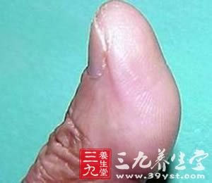 发手机短信会诱发腱鞘炎