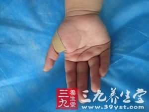 发手机短信会诱发腱鞘炎