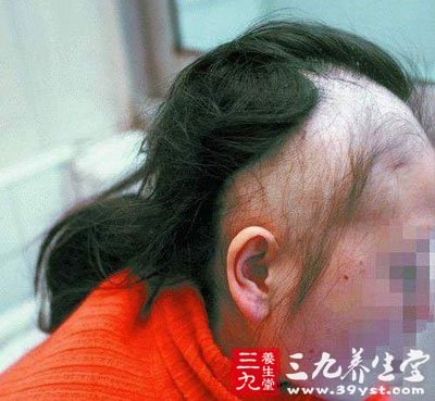 中医推荐治疗斑秃的刮痧疗法