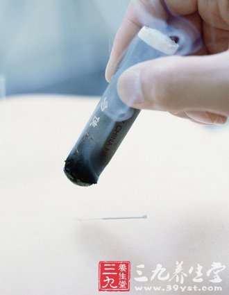 手脚冰凉怎么办 穴位艾灸给你暖暖身