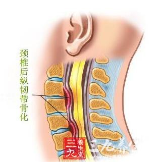 颈椎后纵韧带骨化症