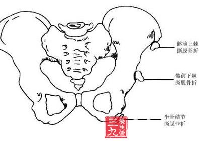 骨盆骨折