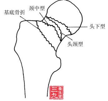 股骨颈骨折