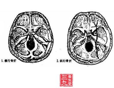 颞骨骨折