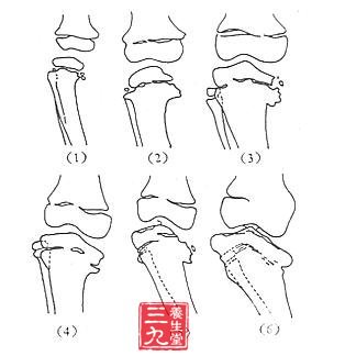 胫骨内髁骨软骨病