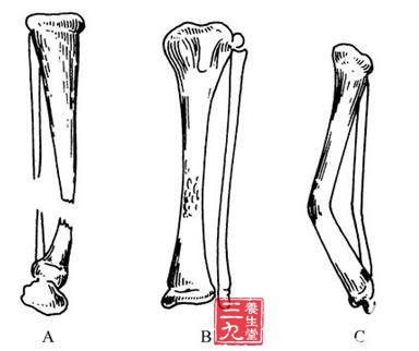 先天性胫骨假关节