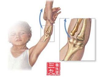先天性桡骨小头脱位