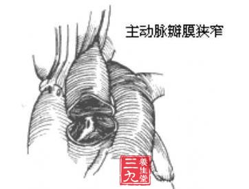 主动脉瓣膜部狭窄