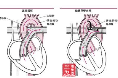 先天性动脉导管未闭
