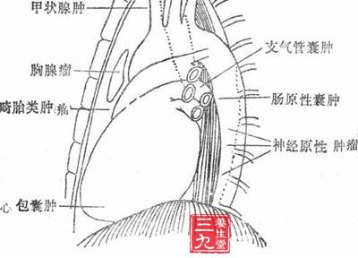 据上海市胸科医院报道的1228例纵隔肿瘤中,以胸腺瘤最为常见,其次为