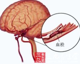脑血栓形成