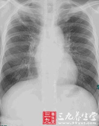 特发性肺纤维化