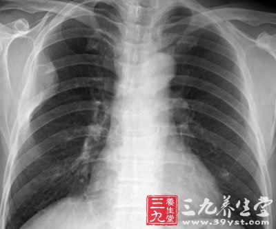 支原体肺炎-三九养生堂