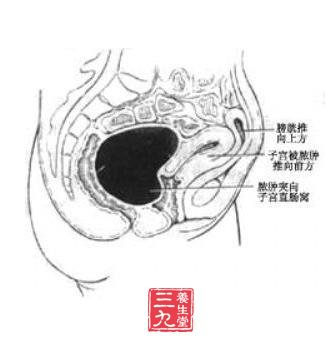 急性输卵管卵巢炎