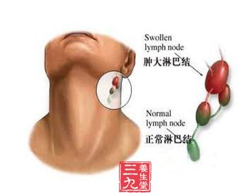 腺淋巴瘤-三九养生堂