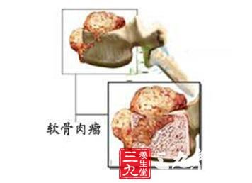 反分化软骨肉瘤