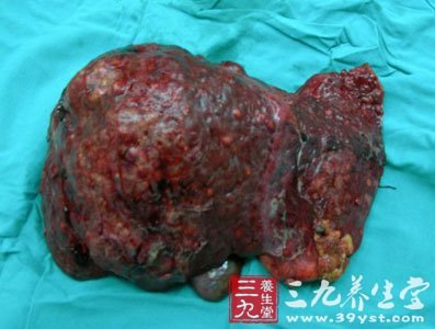 肝癌_肝硬化肝癌患者也可选用扩大肝切除术