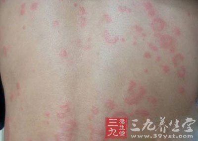 荨麻疹是一种相当常见的皮肤病