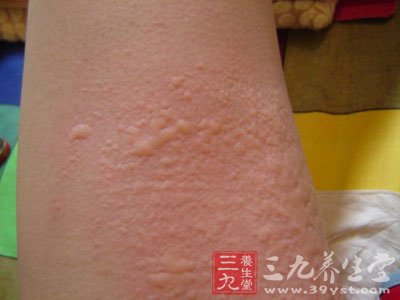 荨麻疹的发生主要是由于过敏变态反应所致