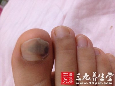 灰指甲的初期症状 不同类型要分清