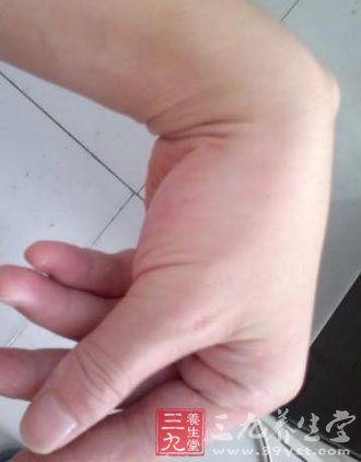 手指关节疼痛的危害